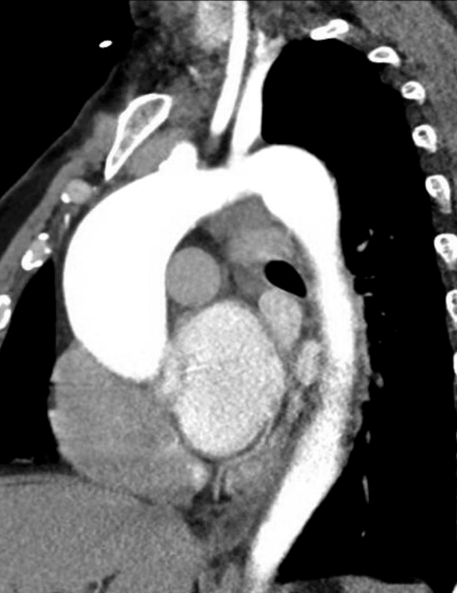 Company-supplied CT angiography example showing the thoracic aorta