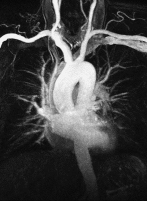 Company-supplied MR angiography example showing the thoracic aorta