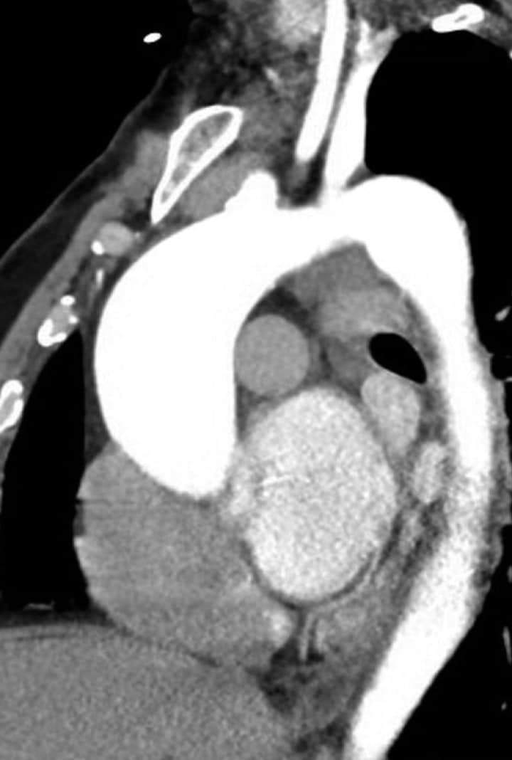 Sagittal CT angiography image showing the thoracic aorta