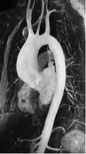 MR angiography image showing the thoracic aorta